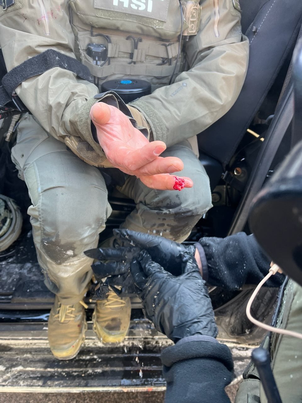 HSI officer after his finger was bitten off. (X/TriciaOhio)